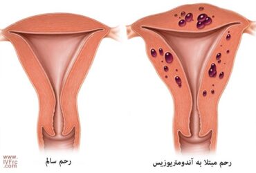 ضخامت آندومتر و عوامل افزایش ضخامت اندومتر