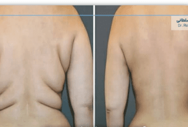 آیا پس از لیپوماتیک شکم ساعت شنی، پوست شل می‌شود؟